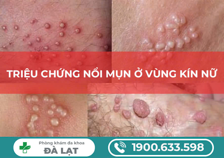 Hỏi đáp cùng chuyên gia: Mọc mụn vùng kín nữ là bệnh gì? Có điều trị được không?